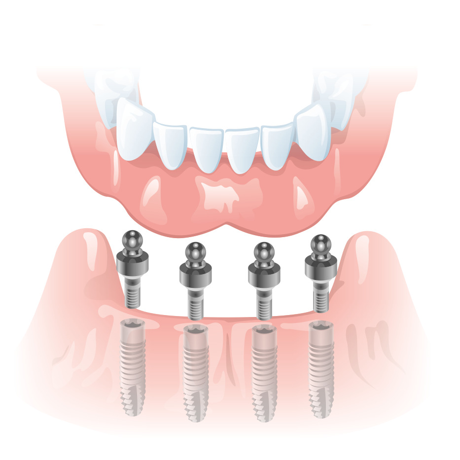 Все на четырех. Съёмный протез (фиксация на имплантатах) балочная фиксация. Съемный протез на шаровидных абатментах. Покрывной протез на имплантах. Несъемный протез с опорой на 4 импланто.